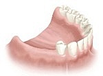 Several Missing Teeth