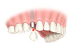 Single implant with crown 