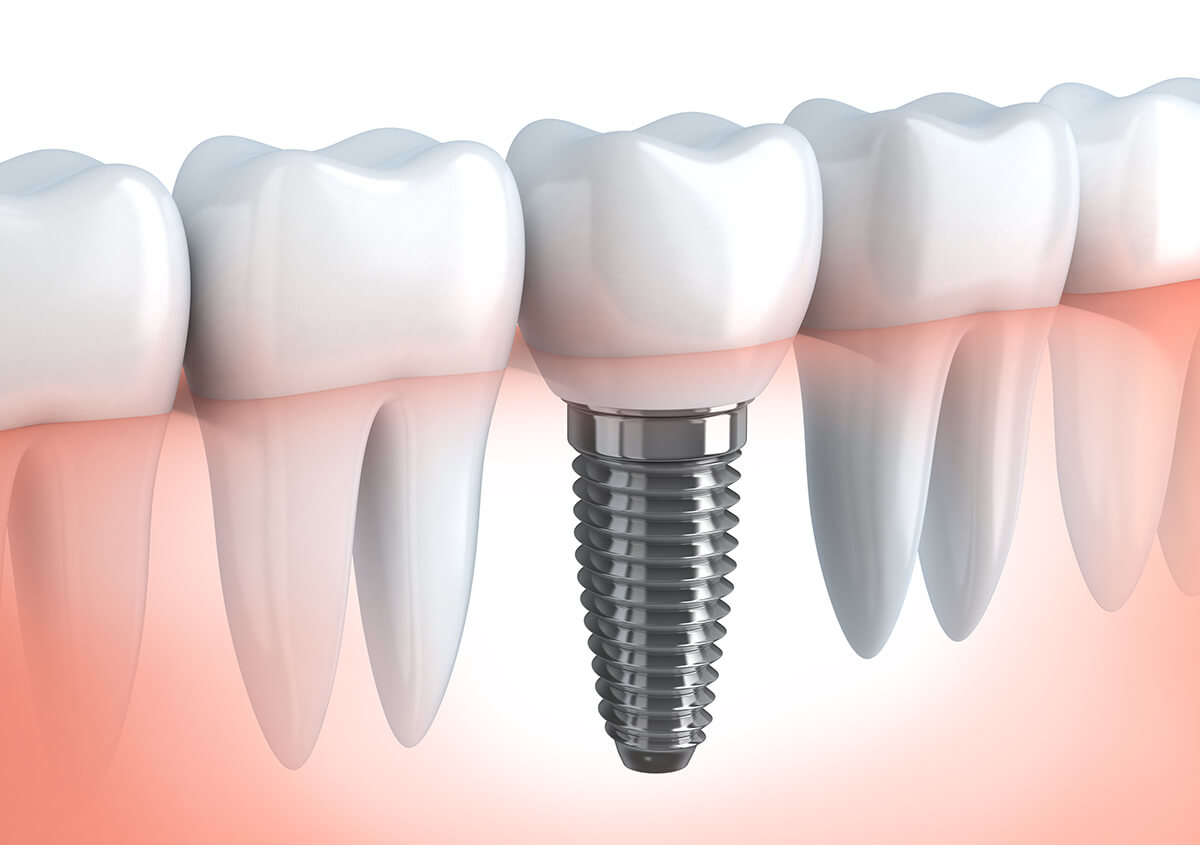 Dental implant solutions from a biological approach