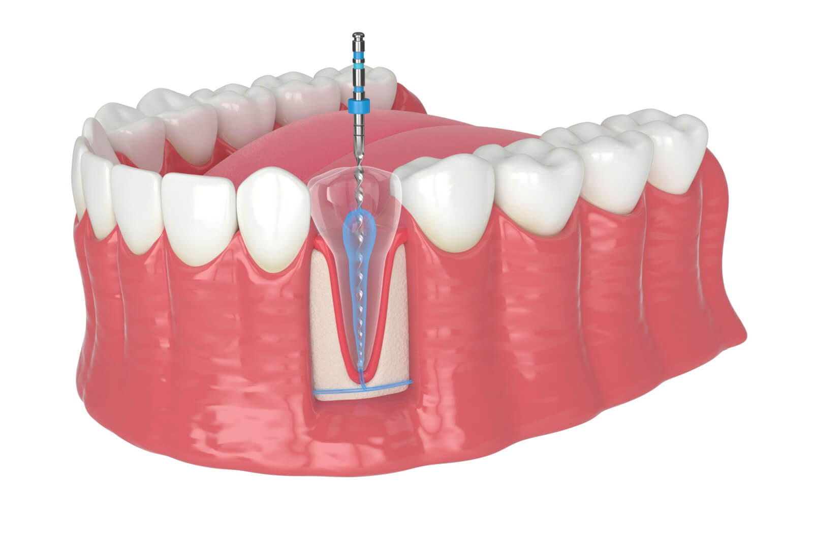 A three-dimensional dental model image illustrates how a root canal is being done